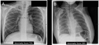 Ứng dụng học sâu trong chẩn đoán X-quang ngực nhi khoa: Tái định hướng một công cụ thương mại phát triển cho người lớn